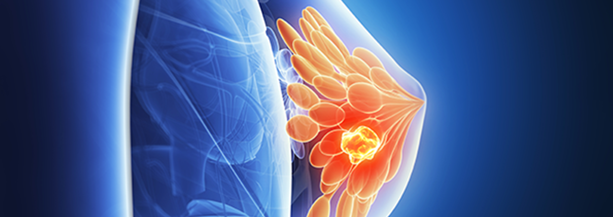 Breast Cancer Recurrence Risk